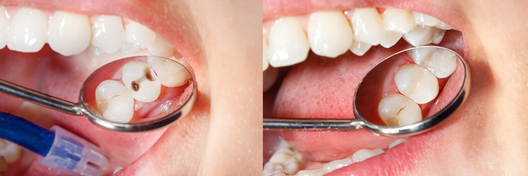 Karies und Zahnfüllung